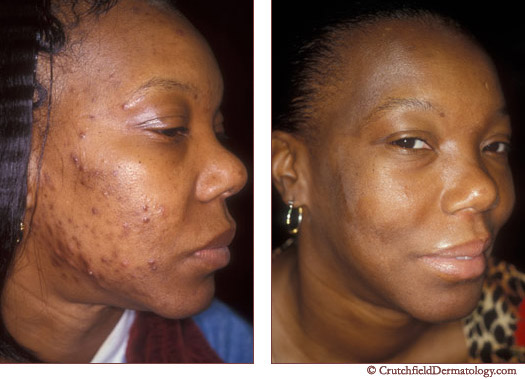 Acne Before & After acne-0013.jpg