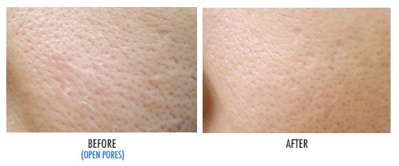 ONLY AestheticsLaser Skin Treatment | Treats Pimples ...